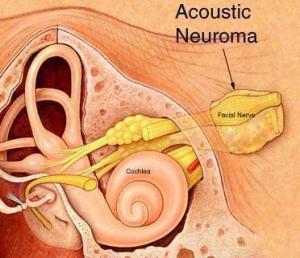 Радиохирургия невриномы слухового нерва в Израиле